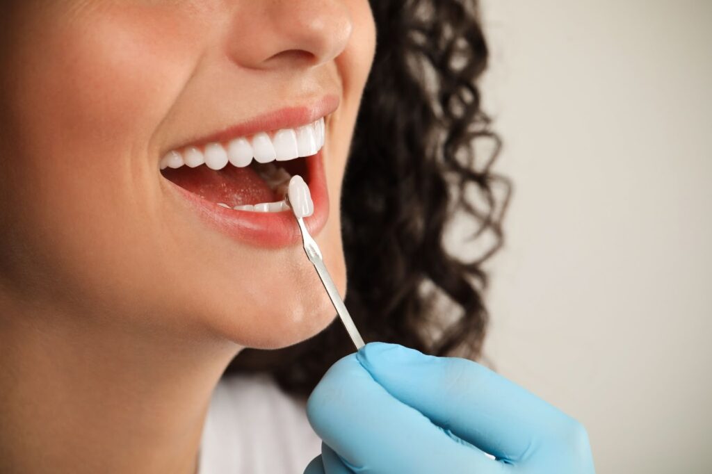 The Benefits of Cosmetic Bonding vs. Veneers